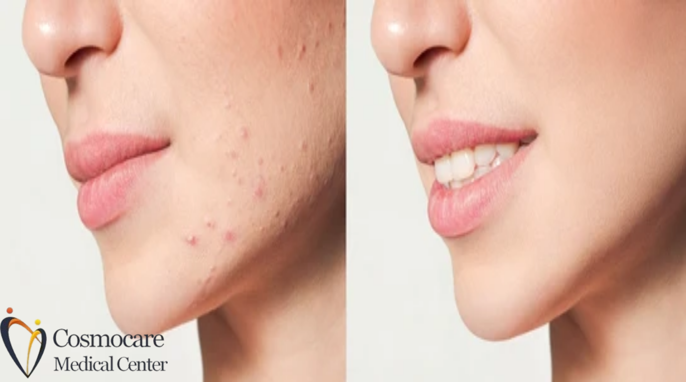 Acne Scar Treatment In Dubai by Cosmocare Medical Center