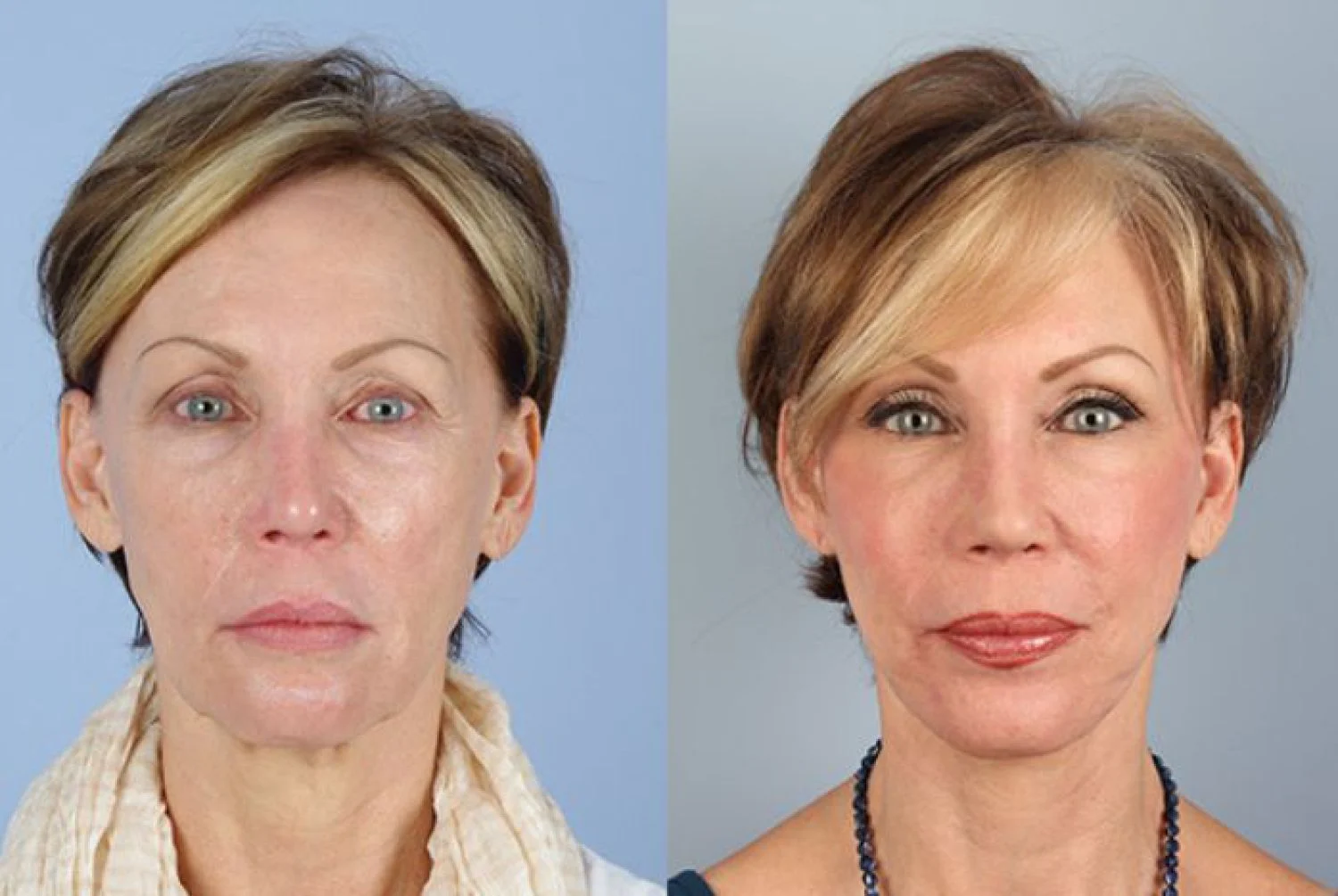 Botox Before After
