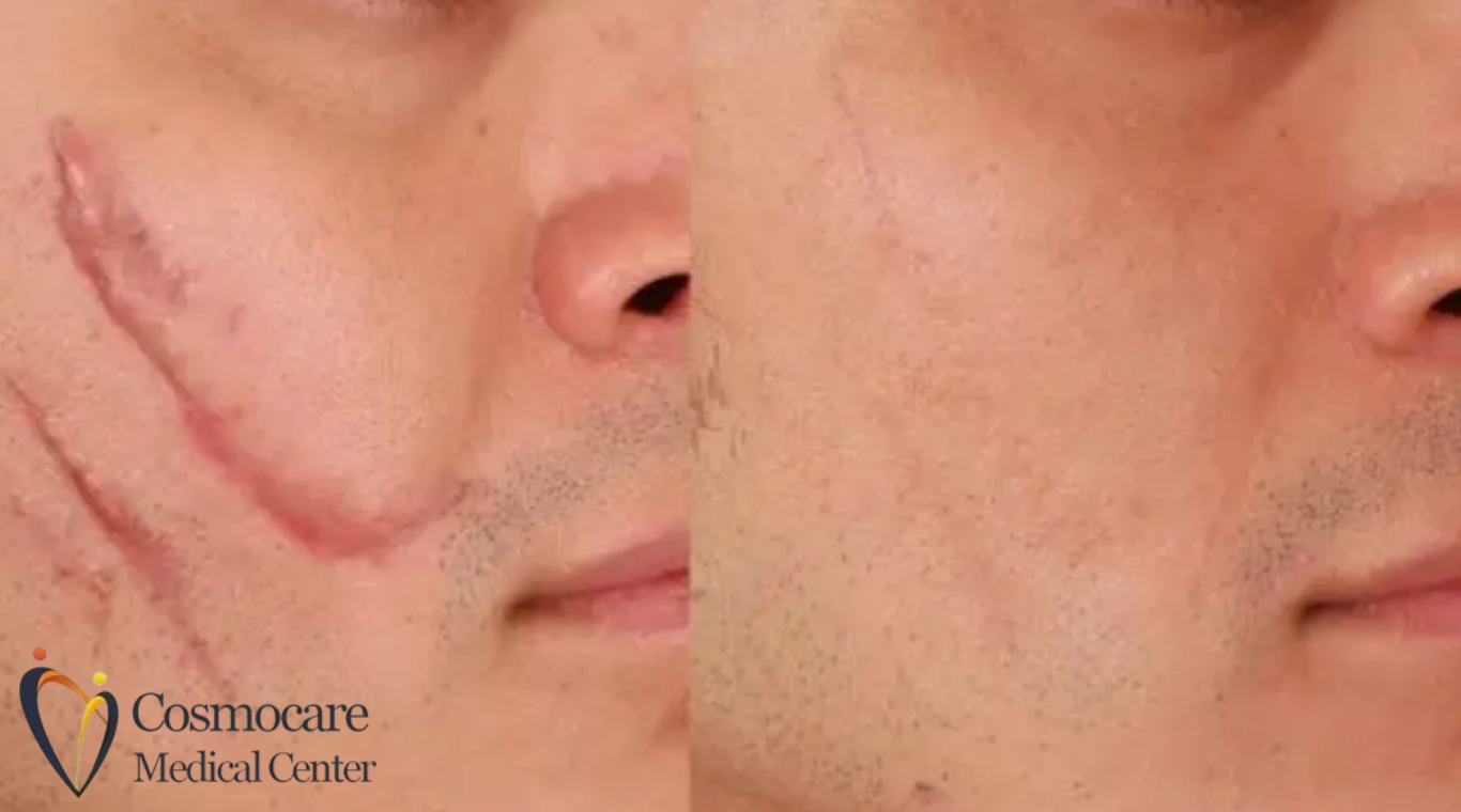 Post Surgical Scars Treatment in Dubai by Cosmocare Medical Center