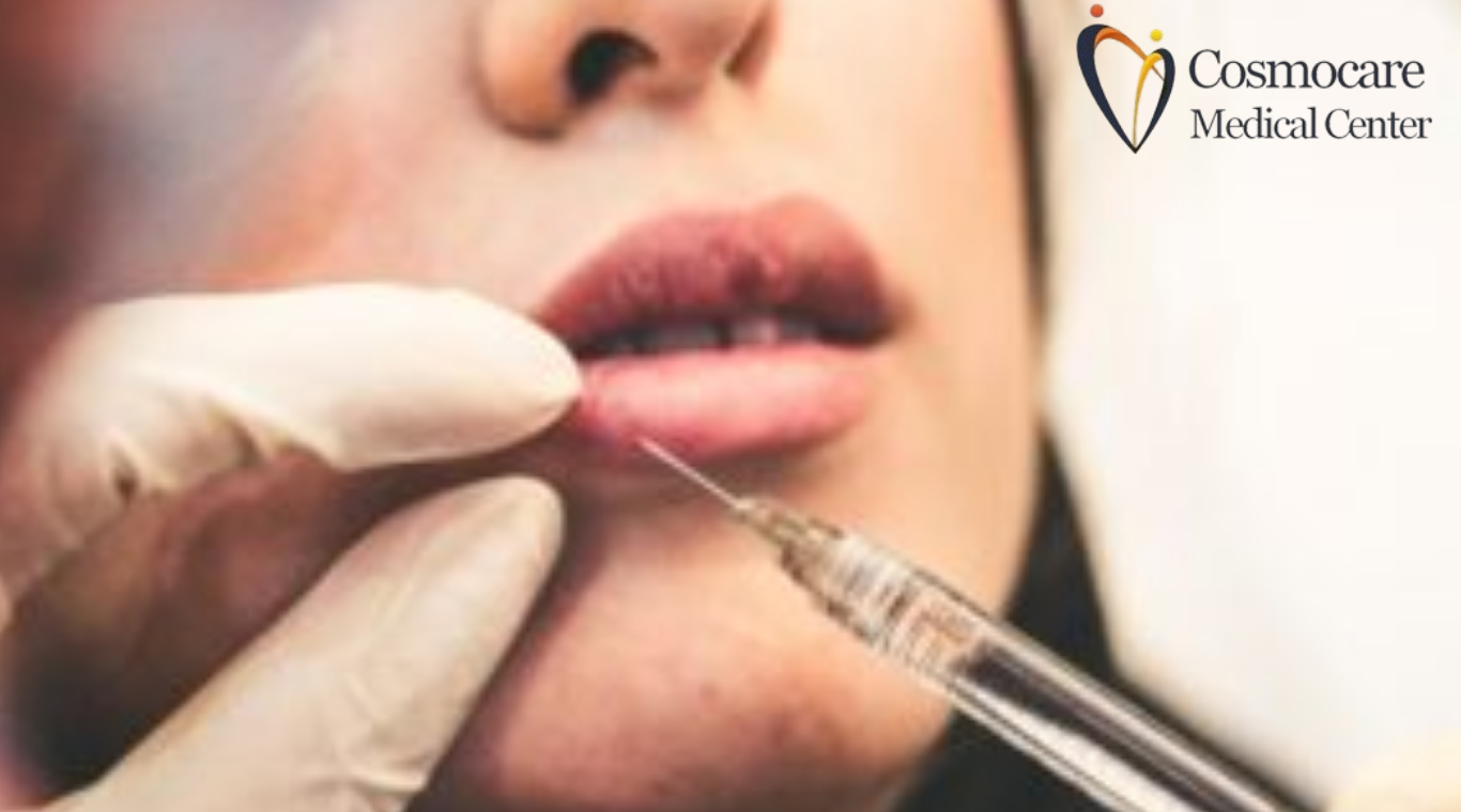 O Smoker Lips Treatment In Dubai by Cosmocare Medical Center